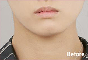 Before-and-after photo of V-line results after Contour Tox 4 types treatment