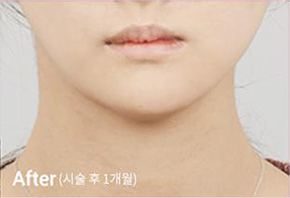 Before-and-after photo of V-line results after Contour Tox 4 types treatment