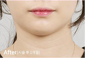 Before-and-after photo of V-line results after Contour Tox 4 types treatment