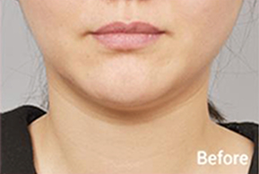 Before-and-after photo of V-line results after Contour Tox 4 types treatment