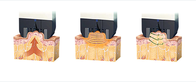 Image explaining how InMode's HVP technology affects the epidermis, dermis, and SMAS layers
                                        