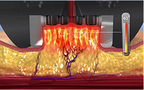Image showing the effects of InMode FX mode on skin layers