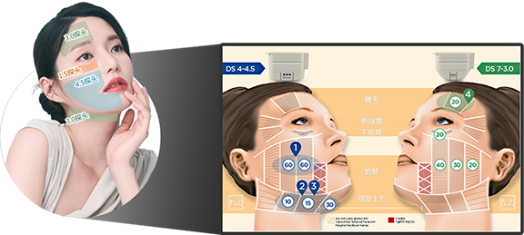 Explanation of various Ulthera tip types tailored for eyebrows, lateral orbit, lower orbit, cheeks, and upper neck