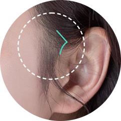Hairline incision location for ID Mint thread lifting